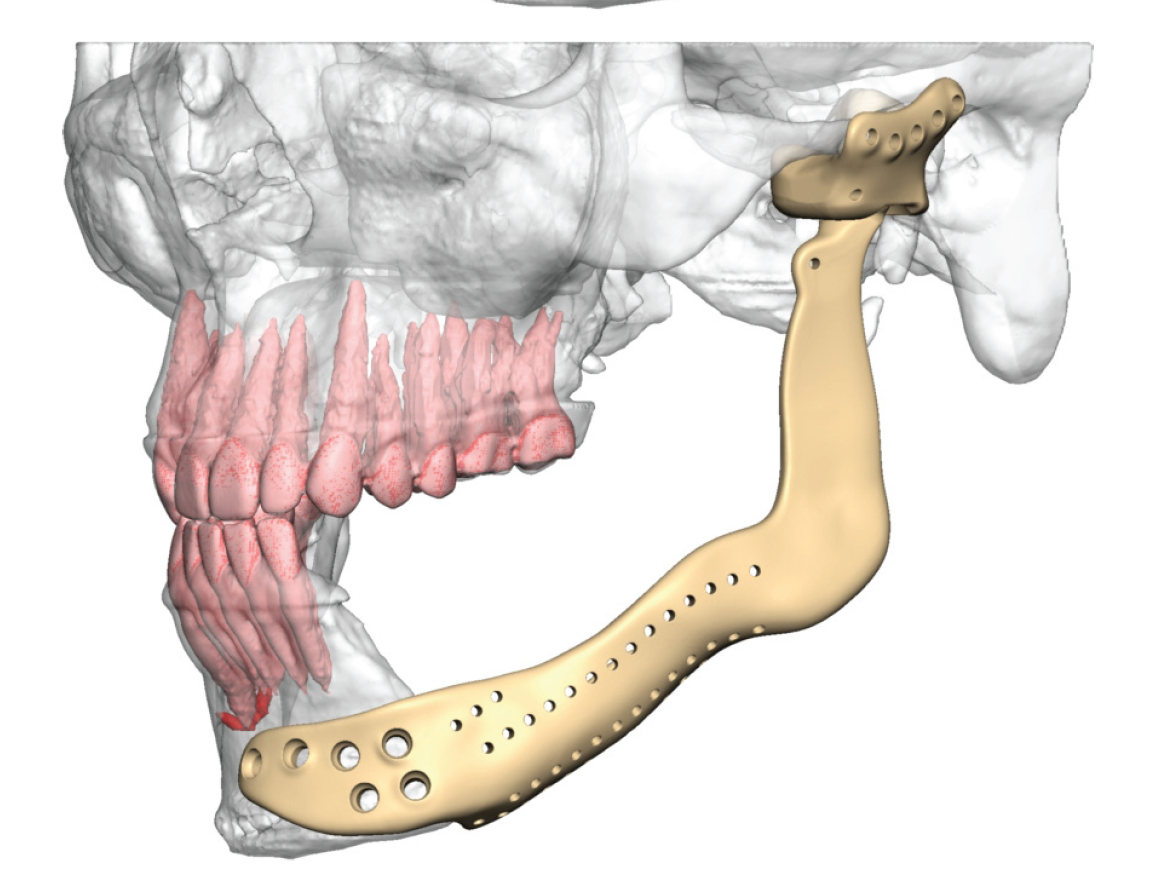 3D model of custom titanium jaw reconstruction prosthesis