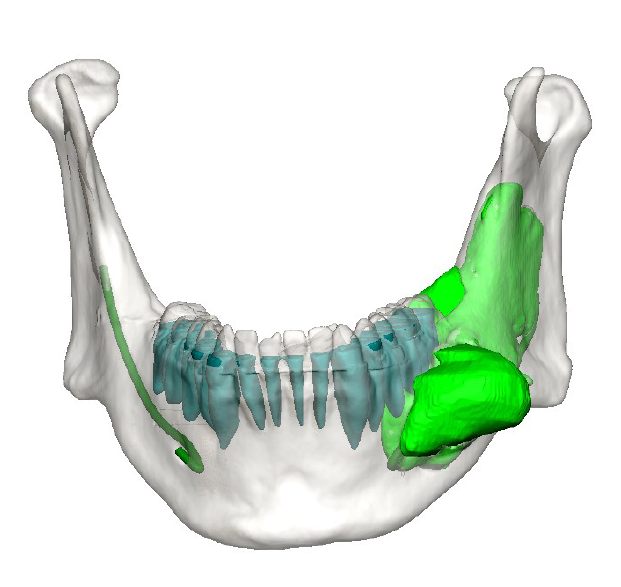 3D CT scan showing jaw cyst/tumor location highlighted in green