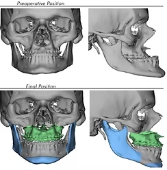 3D virtual surgical planning, preoperative vs final jaw position with custom guides