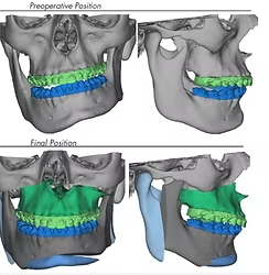 3D virtual surgical planning, preoperative vs final position with cutting guides and splints